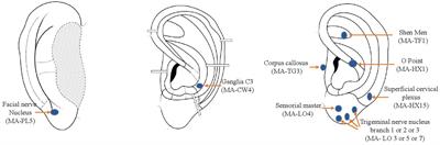 Auriculotherapy in prevention of migraine attacks: an open randomized trial